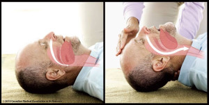 The CPR guidelines should include the head-tilt–chin-lift technique in addition to the recommended chest compression, argues a commentary in CMAJ. (Photo credit: CMAJ)
