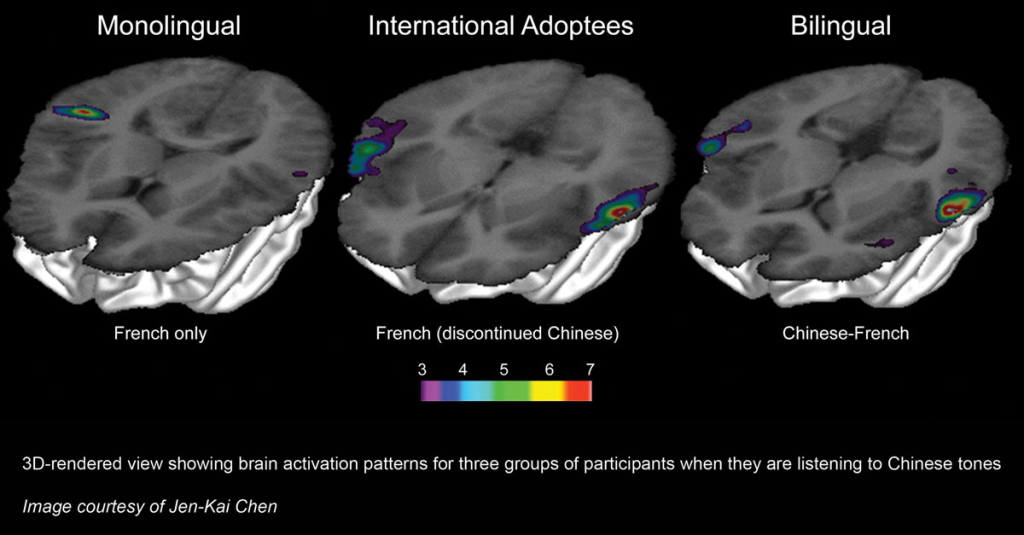 A 3D-rendered view showing brain activation patterns for three groups of participants, French monolinguals (left), French monolinguals with childhood exposure to Chinese (middle), and French-Chinese bilinguals (right), when they are listening to Chinese tones. Individuals with childhood exposure to Chinese display similar activation patterns to bilinguals despite discontinued exposure to Chinese. (Credit: Image courtesy of Jen-Kai Chen)