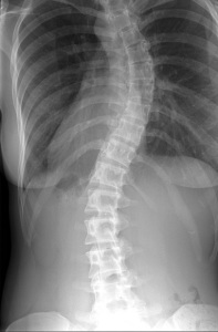 Idiopathic scoliosis is a medical condition by lateral curvature of the spin and a rotation of the vertebral bodies. (Photo credit: Kfergos, flickr.com)