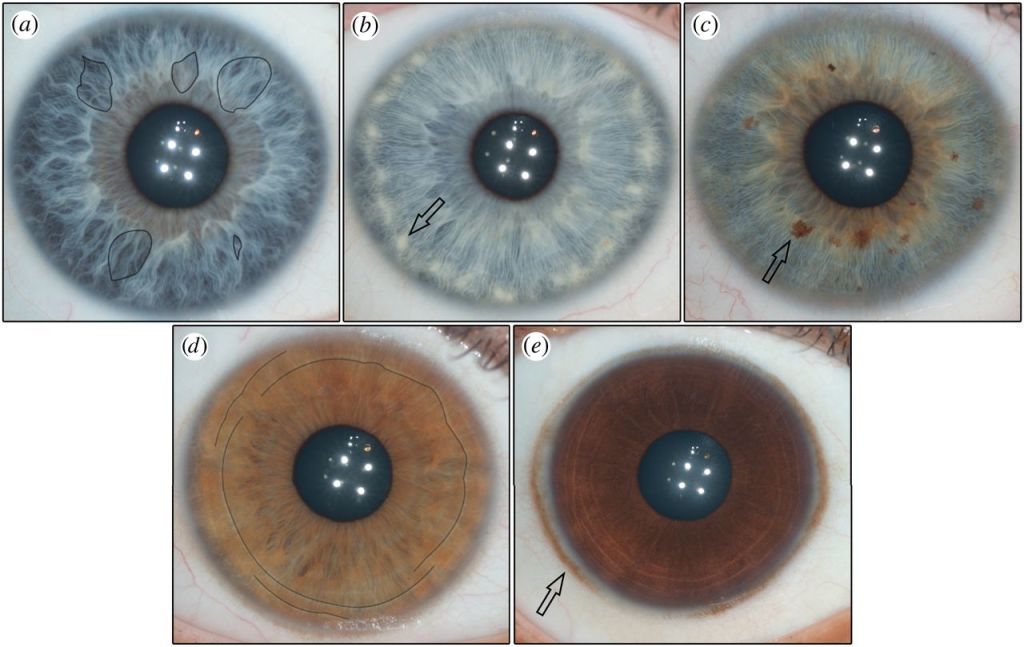 "The five features found most commonly in the human iris. " Fuchs’ crypts (a), wolfflin nodules (b), pigment spots (c), contraction furrows (d), and conjunctival melanosis (e). (Image credit: Edwards et al., The Royal Society Publishing) 