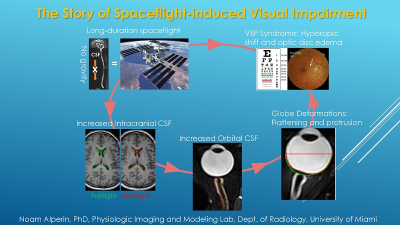 Summary of the spaceflight-induced visual impairment research.