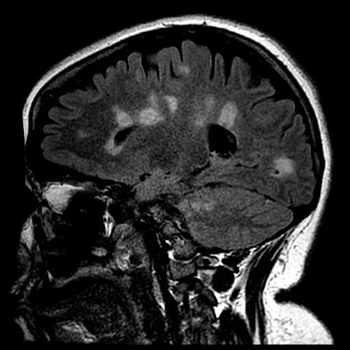 This is an MRI of a person with multiple sclerosis. White areas show permanent scarring caused by the disease. (Image by UBC)