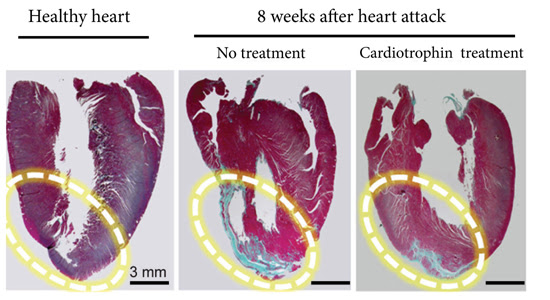 The far right image shows how a cardiotrophin treatment repaired heart muscle after a heart attack in a rat model. The blue areas are scar tissue and the red sections are healthy heart muscle (Cell Research/Medley et al., 2017)