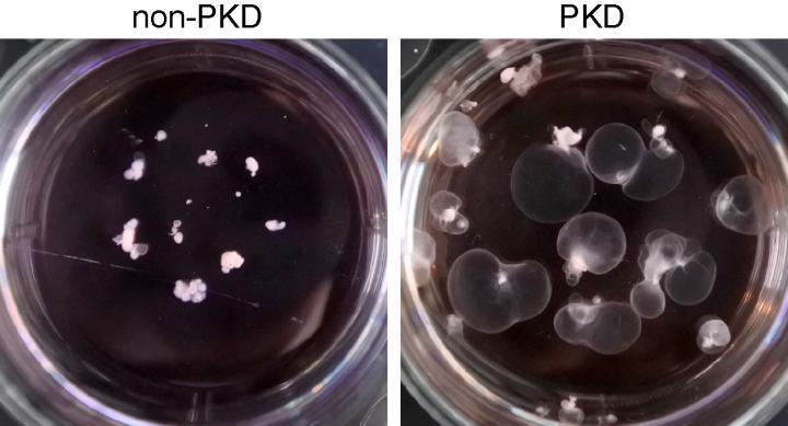 Kidney organoids grown in the lab and suspended in a lab dish show the formation of cysts (right) in the disease model of polycystic kidney disease. Normal kidney organoids are on the left. (Image via Freedman Lab/UW Medicine)