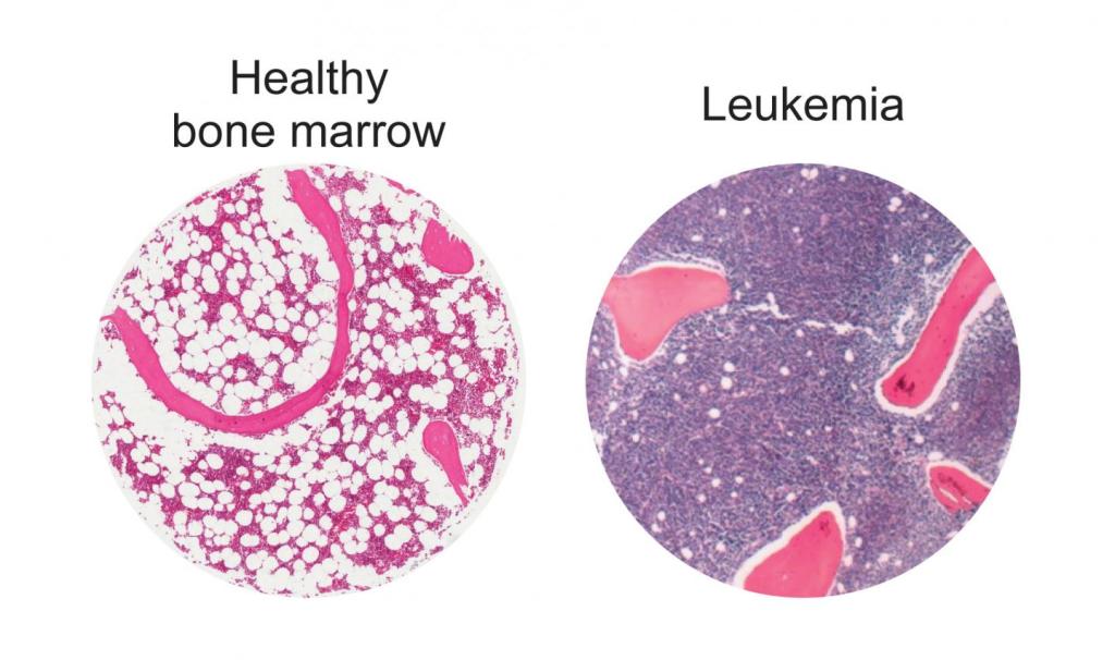 These are fat cells (white circles) in healthy human bone marrow, left, compared to bone marrow in a patient with leukemia, right. (Image courtesy McMaster University)